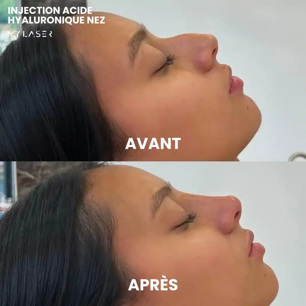 Injection Acide Hyaluronique | Infos et tarifs