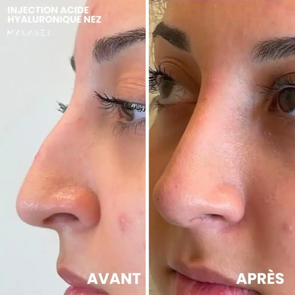 Injection Acide Hyaluronique | Infos et tarifs
