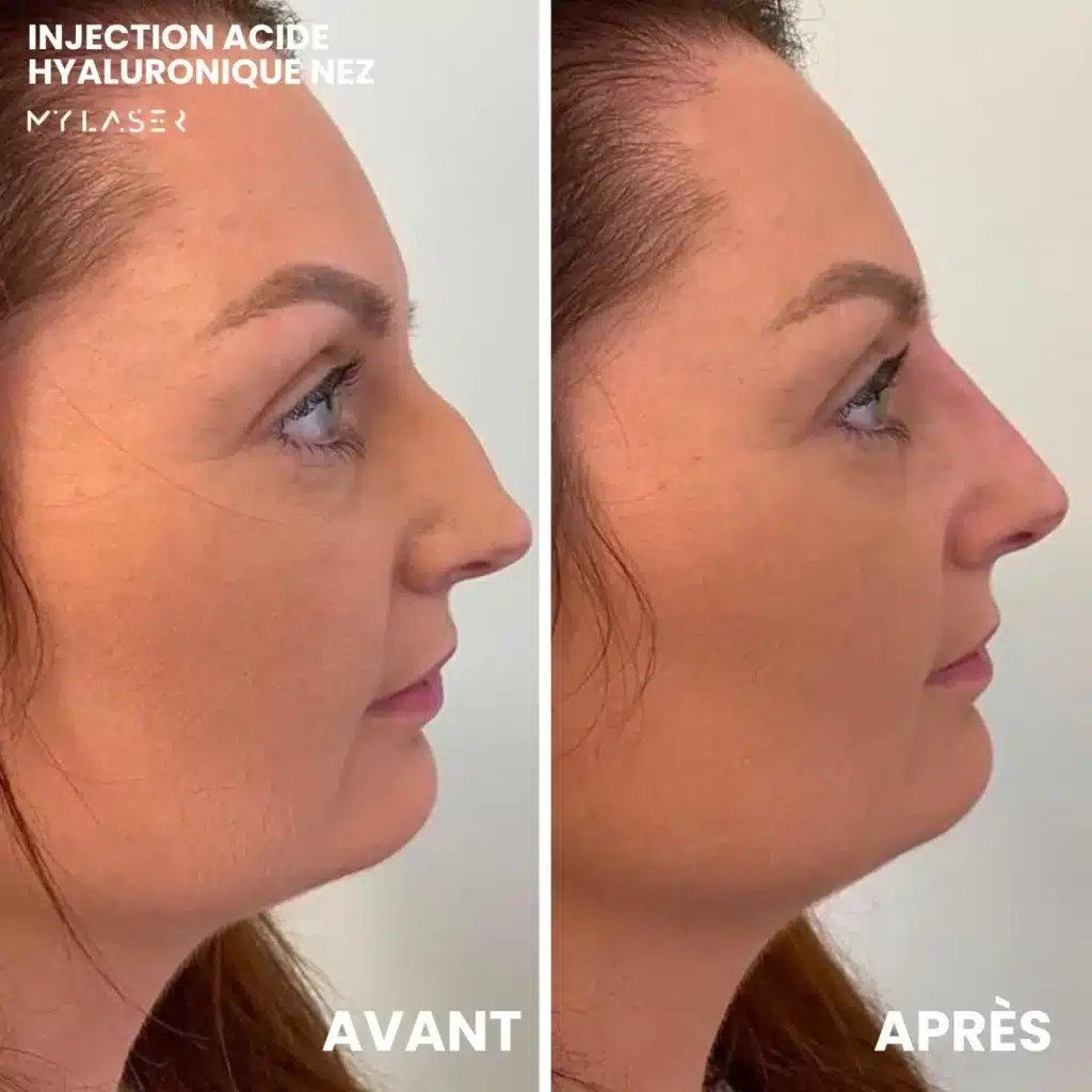 Injection Acide Hyaluronique | Infos et tarifs