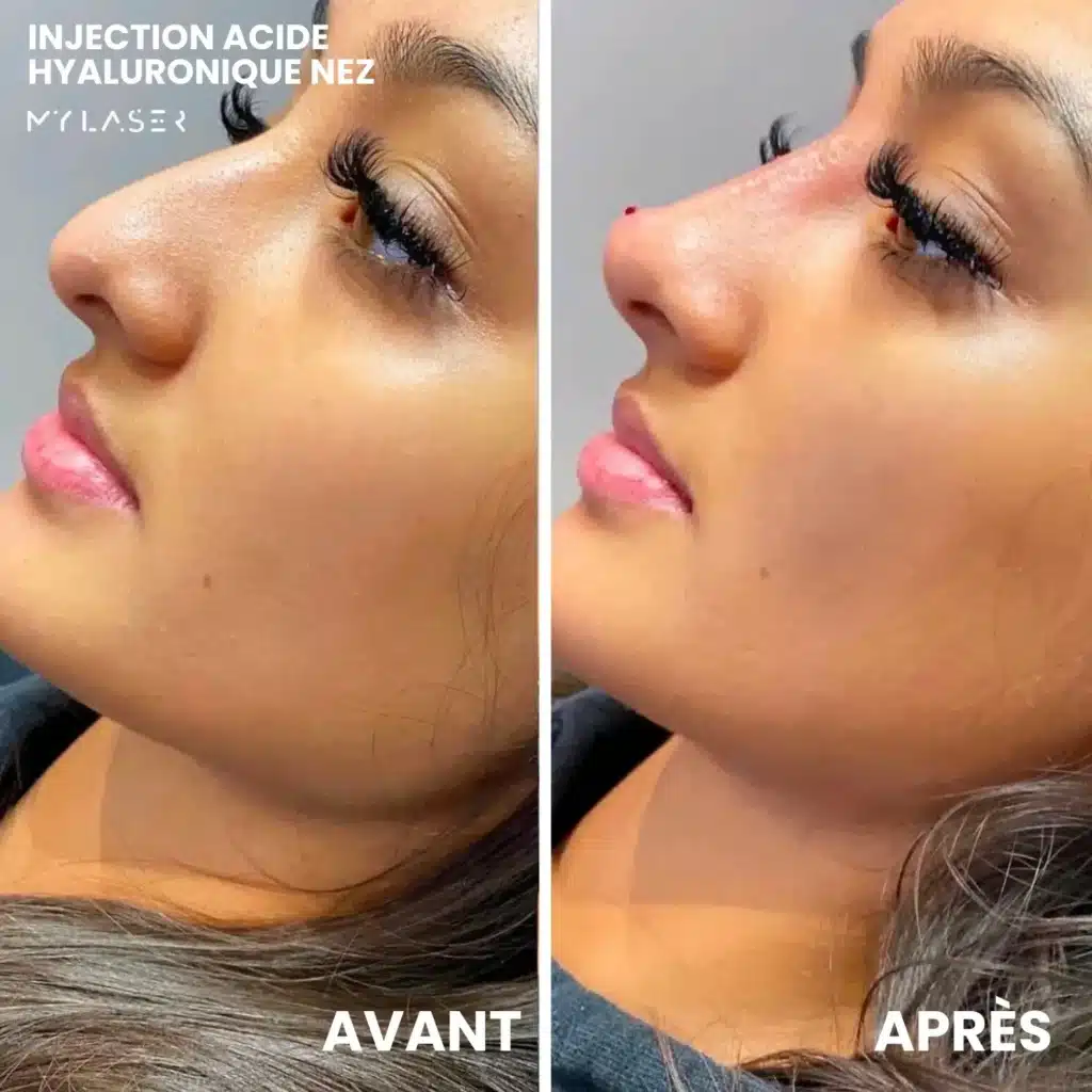 Injection Acide Hyaluronique | Infos et tarifs