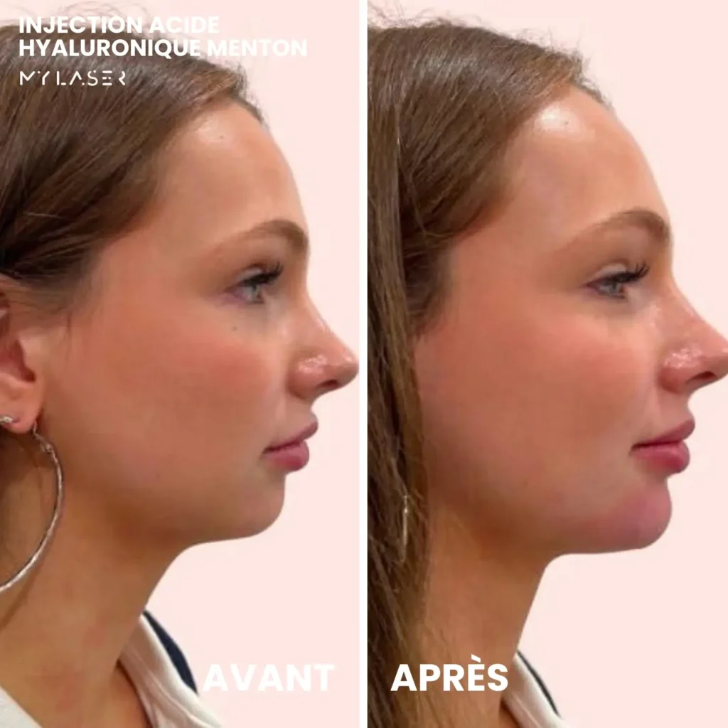 Injection Acide Hyaluronique | Infos et tarifs