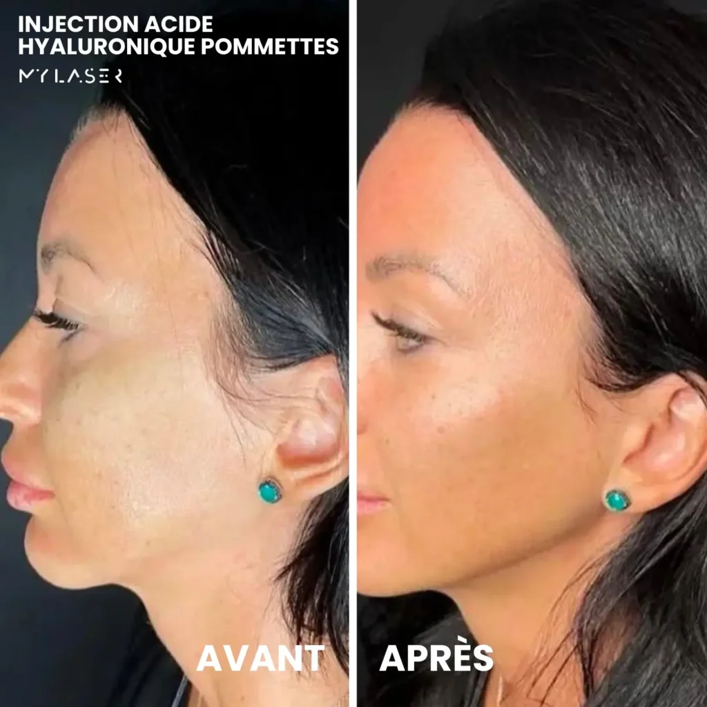 Injection Acide Hyaluronique | Infos et tarifs