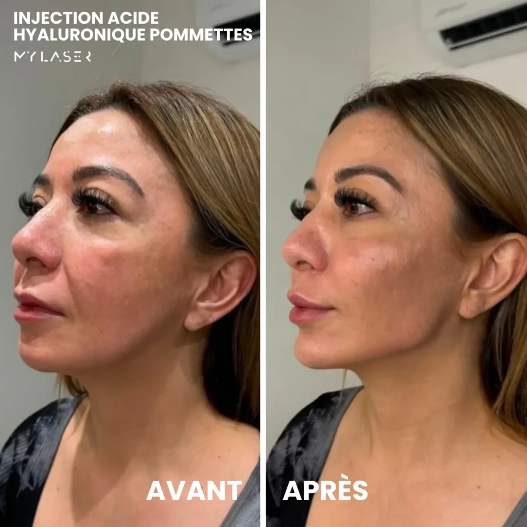 Injection Acide Hyaluronique | Infos et tarifs