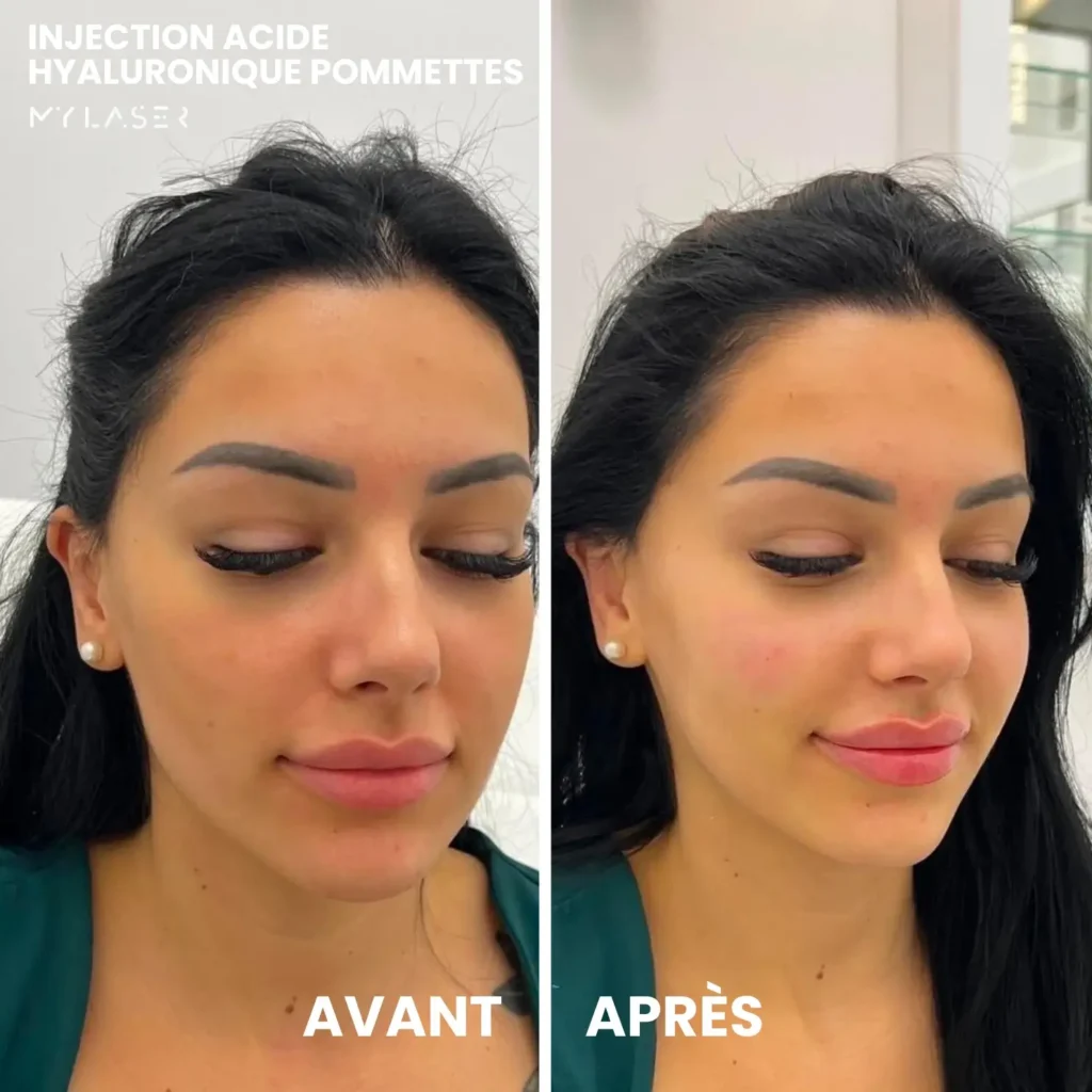 Injection Acide Hyaluronique | Infos et tarifs