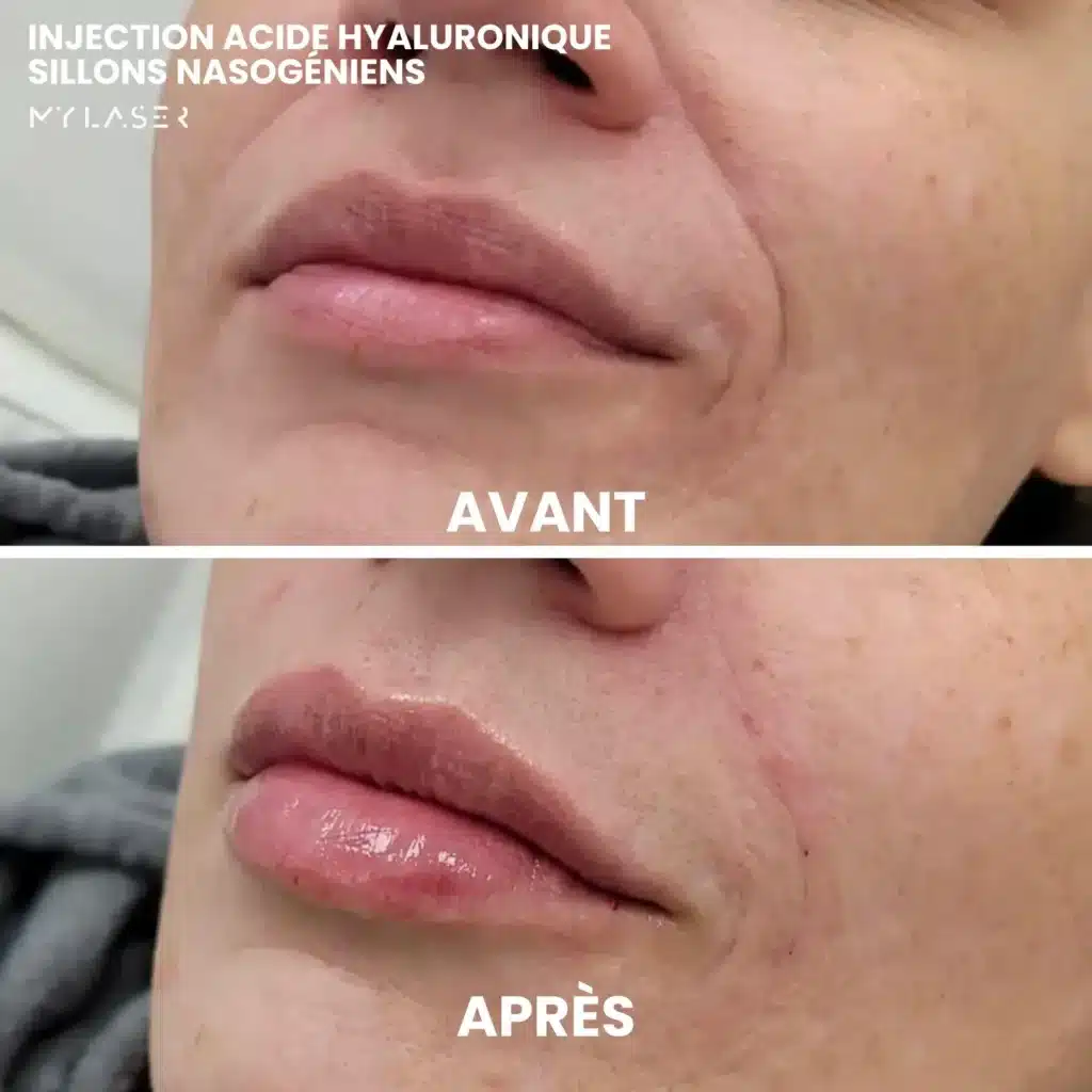 Injection Acide Hyaluronique | Infos et tarifs