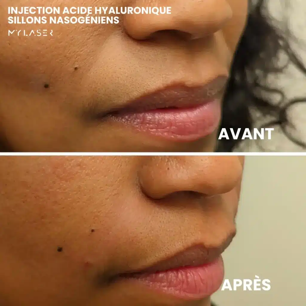 Injection Acide Hyaluronique | Infos et tarifs