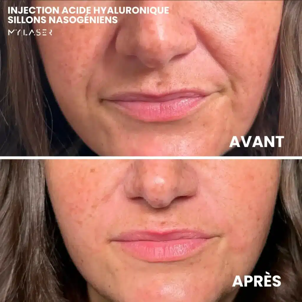 Injection Acide Hyaluronique | Infos et tarifs