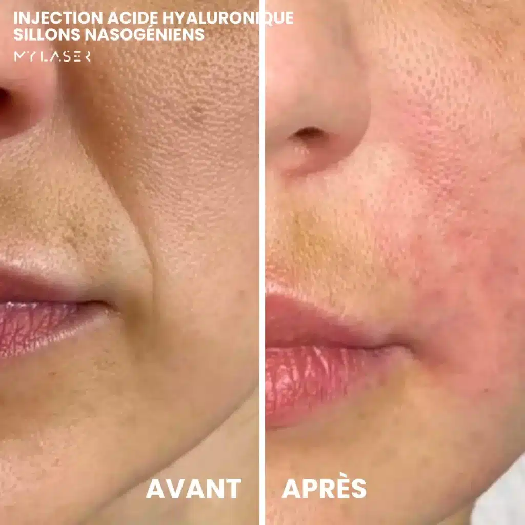 Injection Acide Hyaluronique | Infos et tarifs