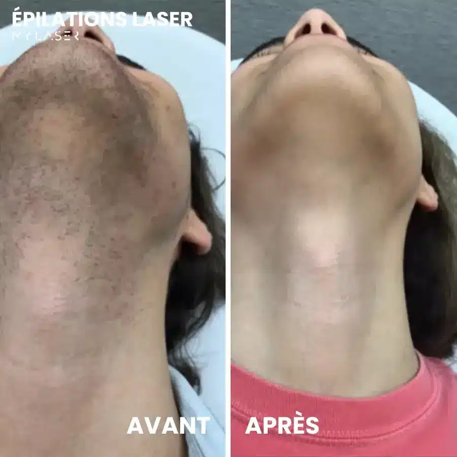 Avant et après épilation laser du cou et du dessous du menton