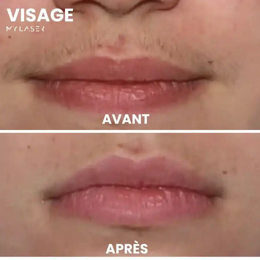 Avant et après épilation laser de la lèvre supérieure