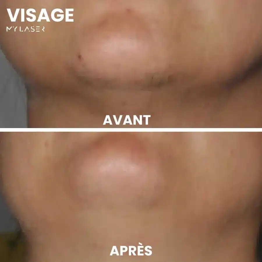 Avant et après épilation laser du menton