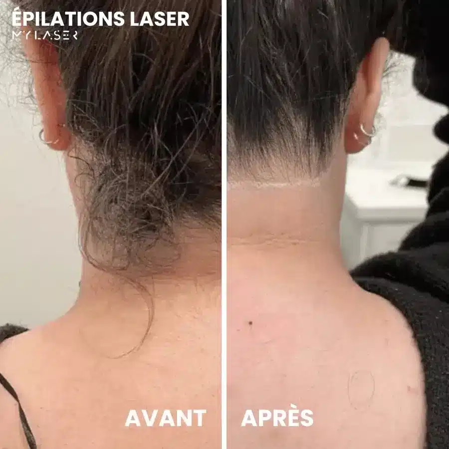 Avant et après épilation laser de la nuque d'une femme