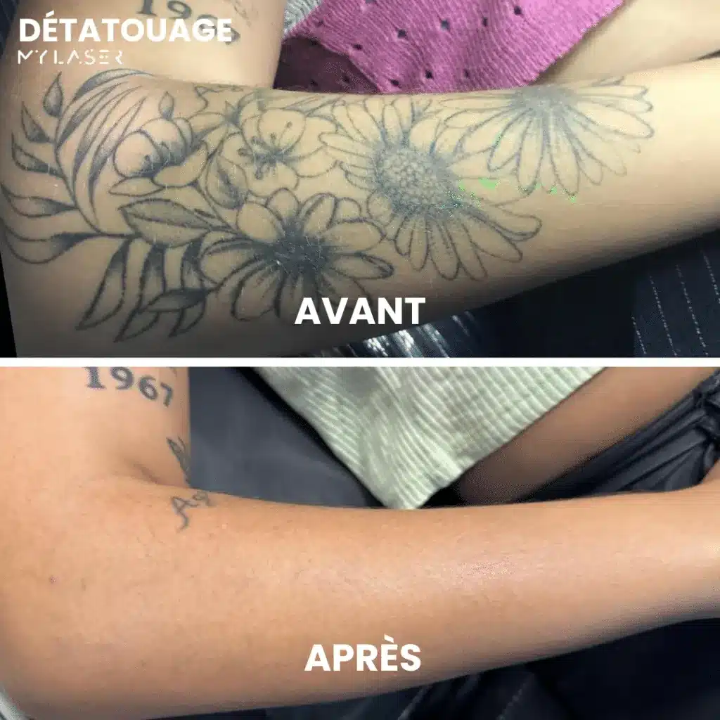 Avant-bras couvert d'un tatouage floral au trait noir, puis sans le motif après le détatouage