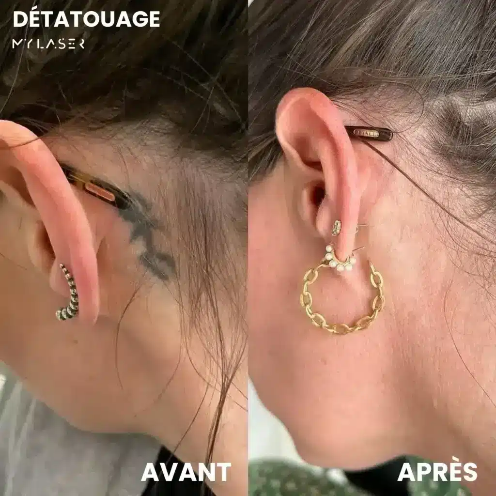 Tatouage noir derrière l'oreille, zone sans encre visible après les séances