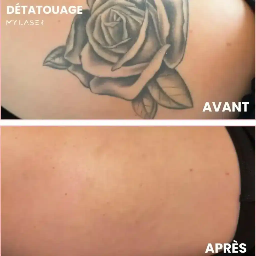 Rose tatouée en noir et gris sur le dos, peau unie après le détatouage
