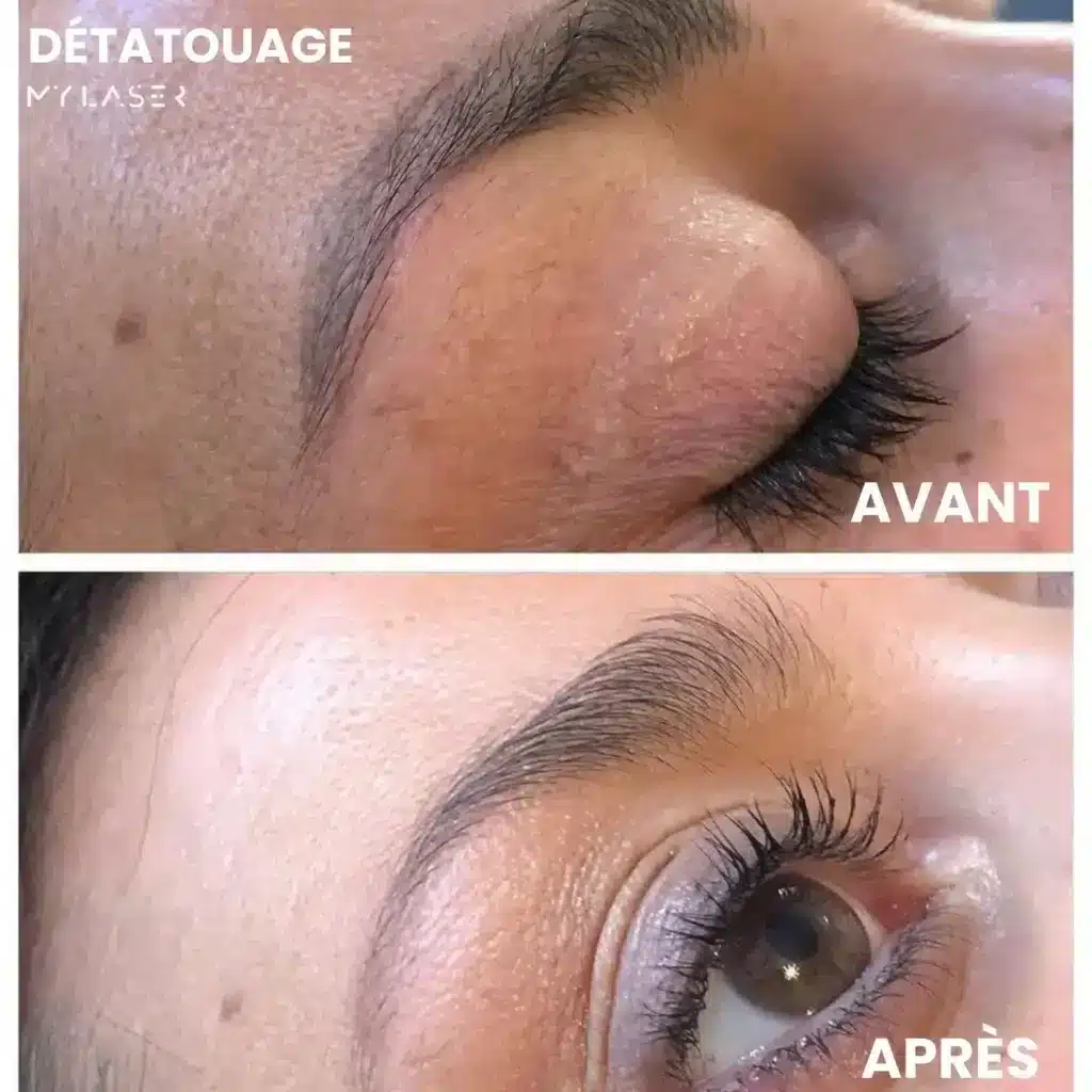 Sourcil au pigment gris avant, puis sourcil naturel après un détatouage au laser