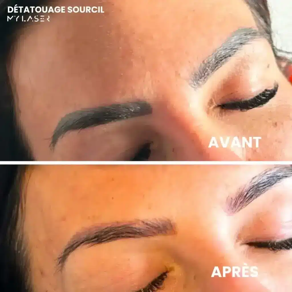 Sourcils tatoués très foncés avant, puis sourcils plus clairs et naturels après un détatouage laser