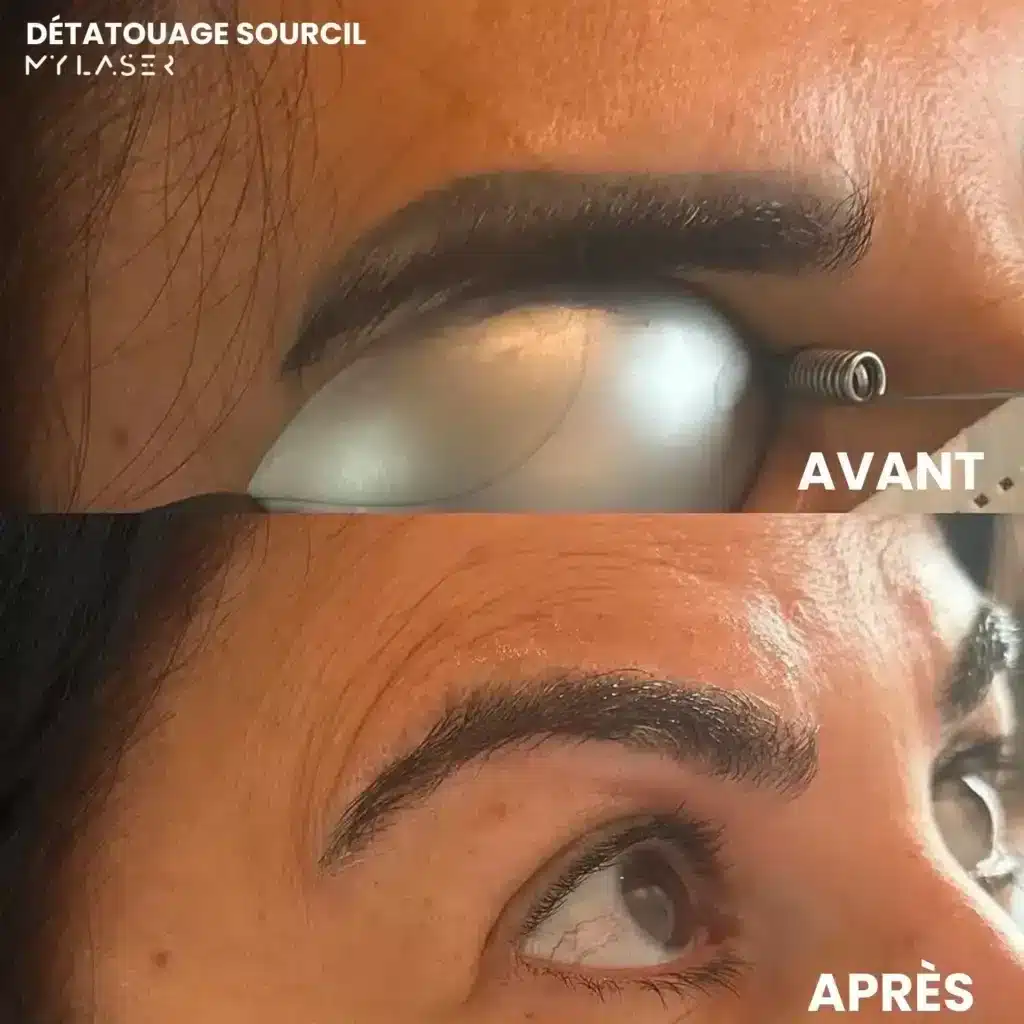 Sourcil tatoué noir, œil protégé par une coque pendant la séance, puis sourcil naturel après le détatouage