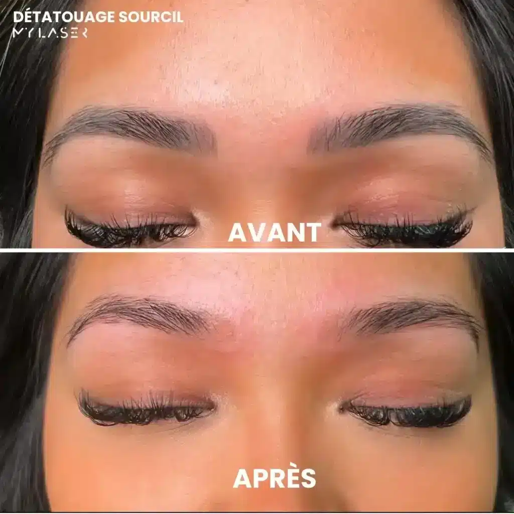 Sourcils au maquillage permanent grisé avant, puis sourcils naturels après un détatouage laser