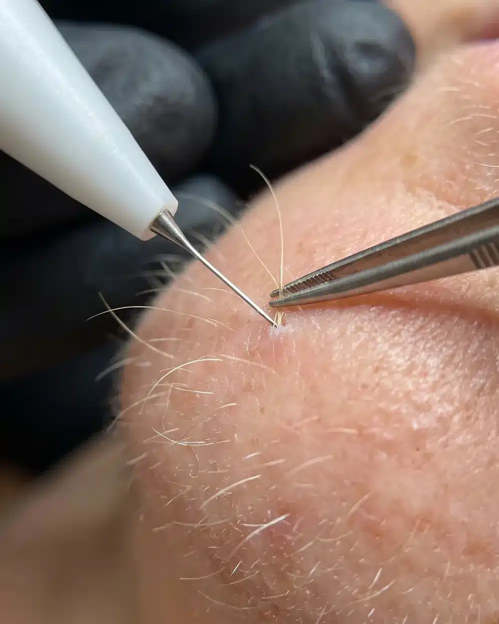 Gros plan de l'aiguille d'électrolyse dans le follicule d'un poil blond, méthode adaptée aux poils clairs et blancs
