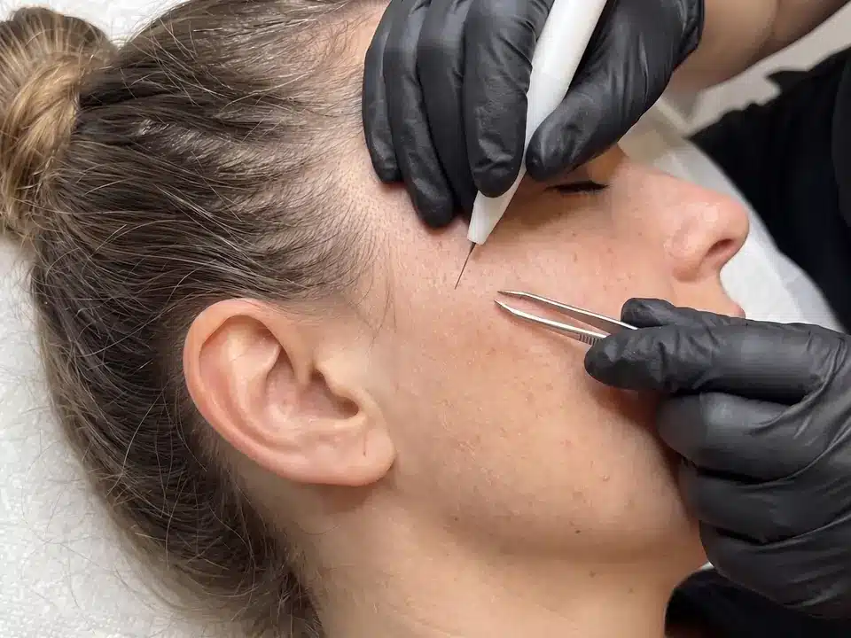 Électrolyse des favoris et des pattes devant l'oreille