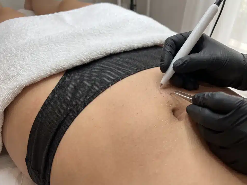 Électrolyse du maillot en toute pudeur, le reste du corps couvert d'une serviette