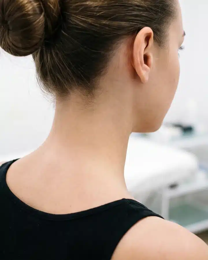 Nuque lisse et sans poil après plusieurs séances d'épilation laser chez My Laser