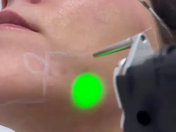 Épilation laser de la mâchoire et du cou d'une femme chez My Laser : zone quadrillée et faisceau de visée vert