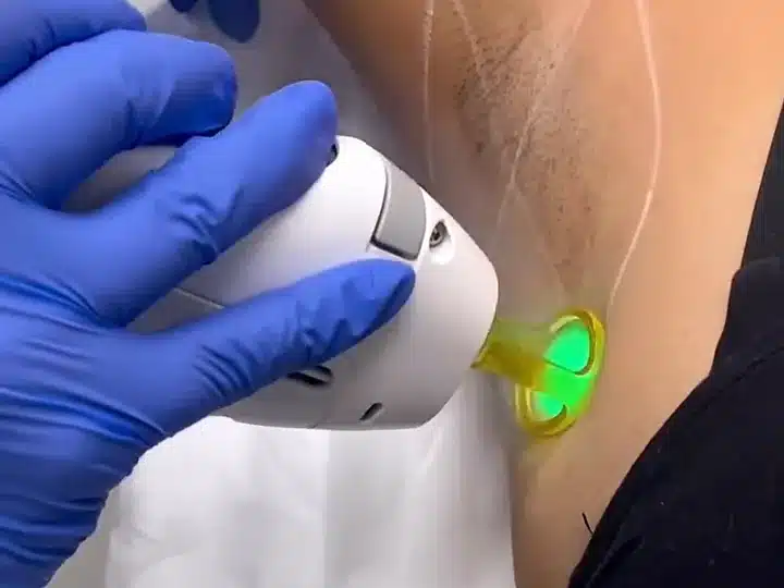 Épilation laser des aisselles chez My Laser : zone tracée et embout doré