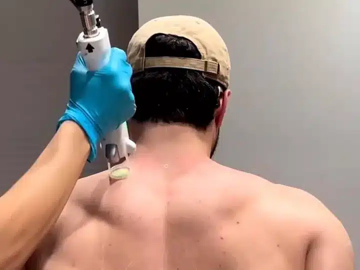 Épilation laser du haut du dos d'un homme dans un centre My Laser