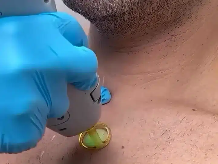 Épilation laser du cou et du contour de barbe d'un homme chez My Laser : embout doré posé sous la mâchoire
