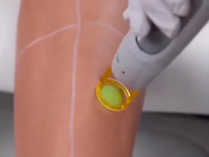 Épilation laser des jambes chez My Laser : pièce à main sur le mollet quadrillé