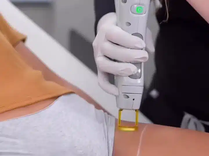 Épilation laser du maillot chez My Laser : pièce à main posée le long du sous-vêtement