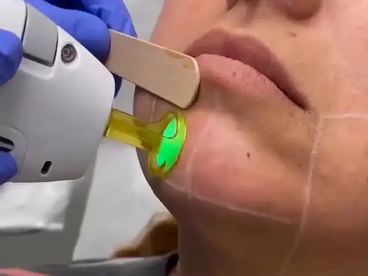Épilation laser du menton chez My Laser : embout doré posé au coin des lèvres