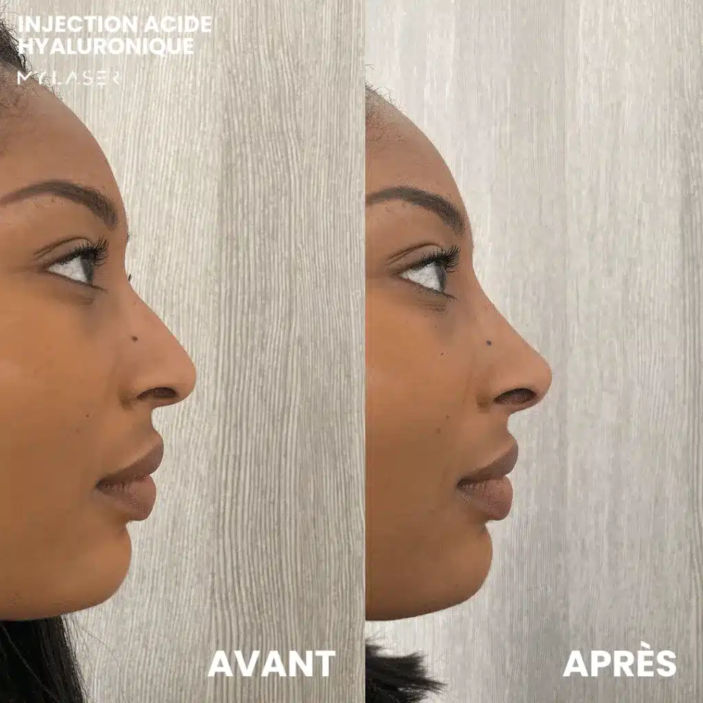 Profil d'une femme avant et après une injection d'acide hyaluronique du nez chez My Laser, arête du nez plus régulière