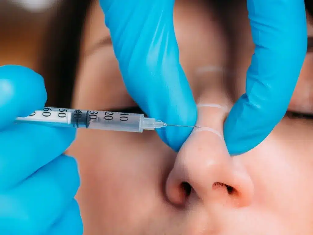 Gros plan d'une rhinoplastie médicale : injection d'acide hyaluronique sur l'arête du nez, doigts gantés tendant la peau