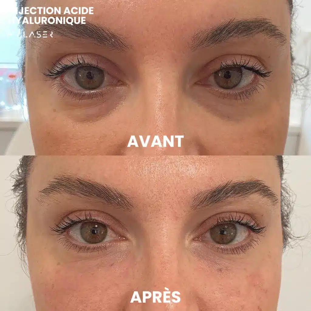 Regard d'une femme avant et après une injection d'acide hyaluronique des cernes chez My Laser, creux sous les yeux atténués