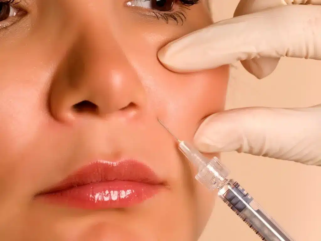 Injection d'acide hyaluronique dans le sillon nasogénien d'une femme, seringue près de la bouche