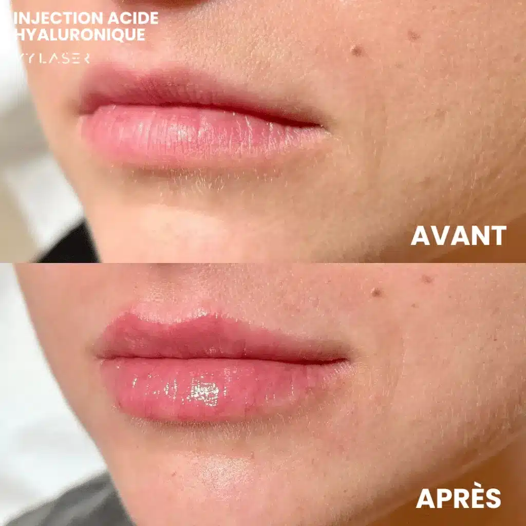 Lèvres d'une femme avant et après une injection d'acide hyaluronique chez My Laser, lèvres plus pleines et contour mieux dessiné