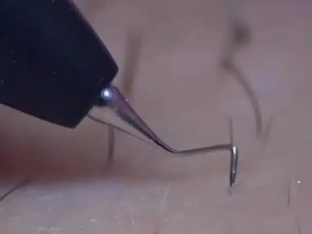 Électrolyse : aiguille coudée du stylet posée au pied d'un poil foncé, gros plan