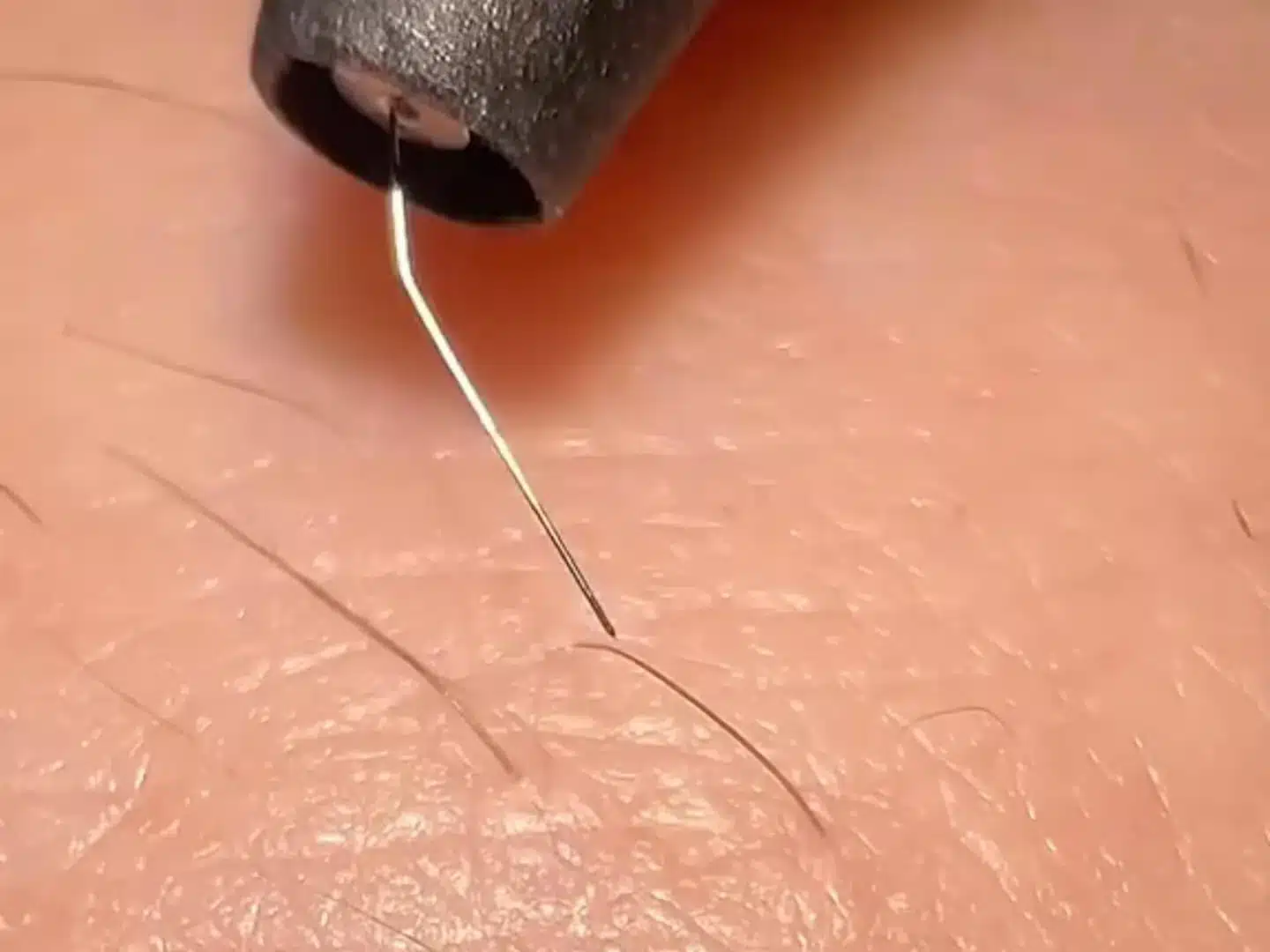Gros plan d'électrolyse : aiguille fine glissée dans le follicule d'un poil clair