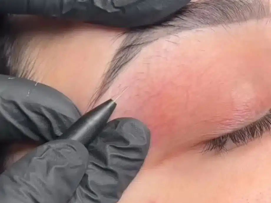 Électrolyse des sourcils : main gantée guidant l'aiguille à la lisière du sourcil