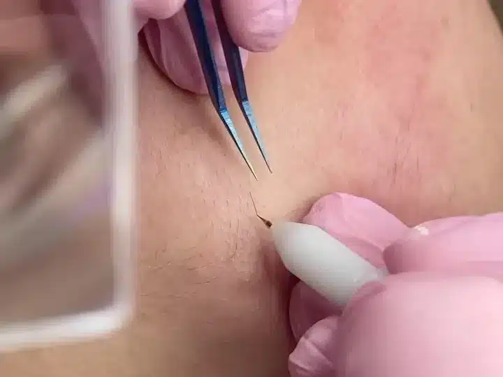 Électrolyse sous loupe : stylet à aiguille et pince fine tenus par des mains gantées