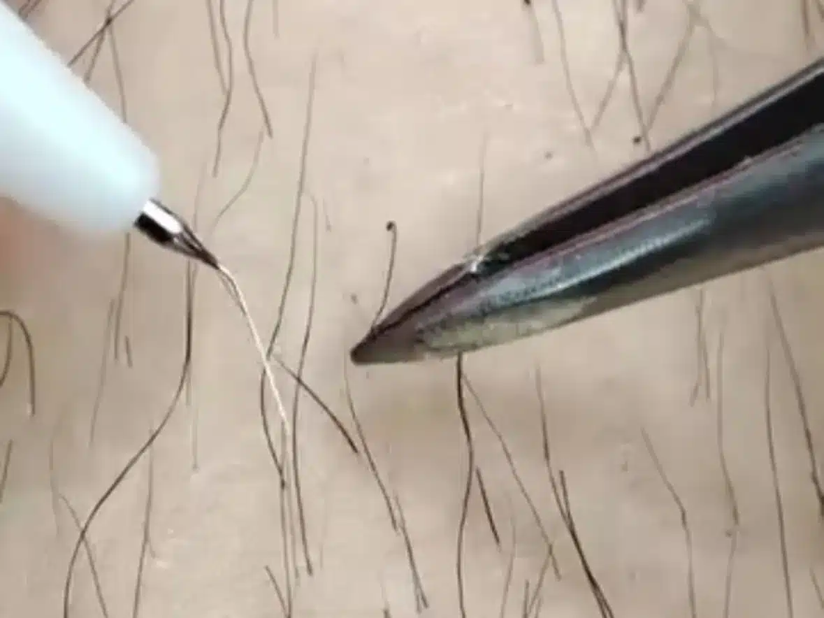 Séance d'électrolyse : aiguille du stylet dans le follicule et pince prête à retirer le poil