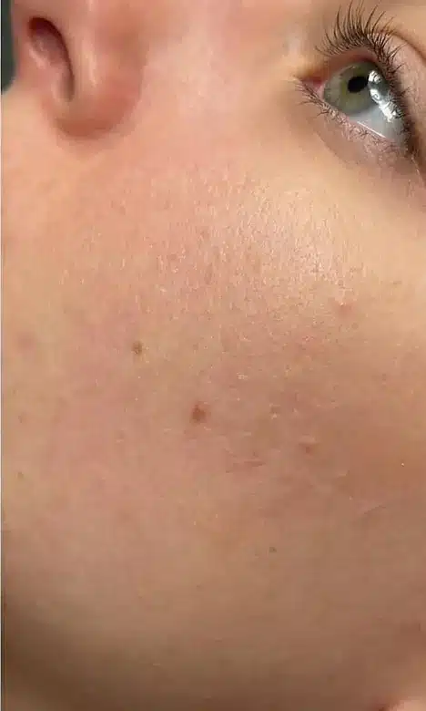 Joue apaisée et nette après le protocole Blemiderm chez My Laser