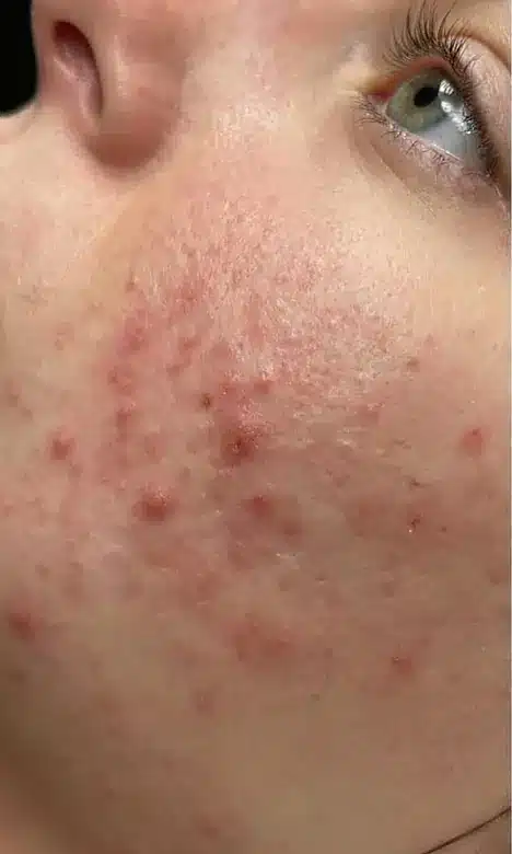 Acné inflammatoire sur la joue avant le protocole Blemiderm chez My Laser