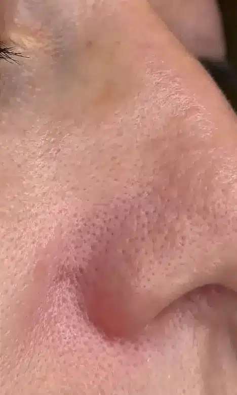 Aile du nez sans rougeurs visibles après le traitement laser de la couperose chez My Laser
