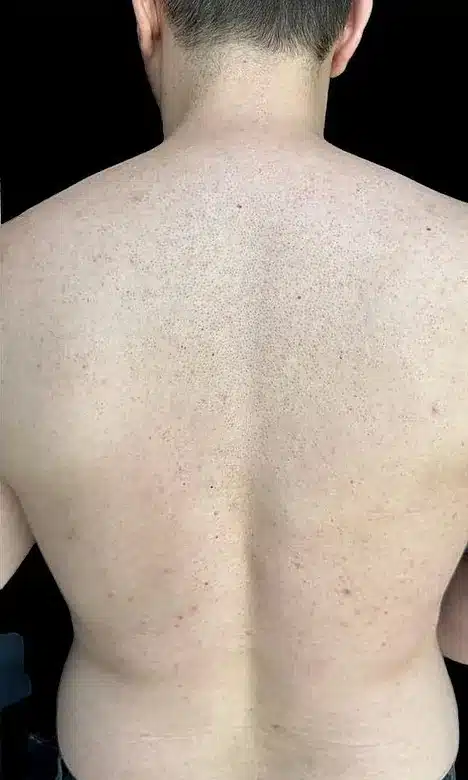 Dos sans tatouage visible après les séances de détatouage laser chez My Laser