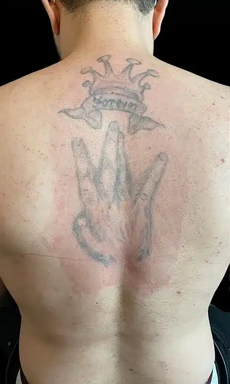 Grand tatouage sur le haut du dos avant le détatouage laser chez My Laser