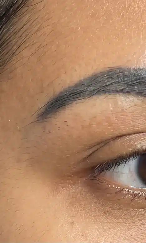 Sourcil au maquillage permanent foncé avant le détatouage laser chez My Laser